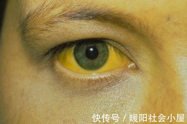 肝硬化|误认为皮肤过敏,结果查出“肝硬化”?皮肤3处异常别再不当回事