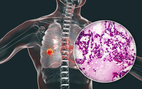  肿瘤的异质|吃靶向药，复查CT发现肺癌病灶有的增大有的缩小，该继续吃药吗