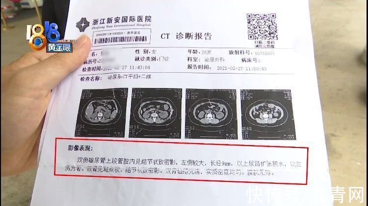 手术支架|术后小便一直出血,手术支架漏取一个