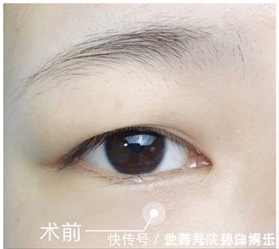 重睑线 眼修复孙沣博士:双眼皮术后是否会产生疤痕和增生?