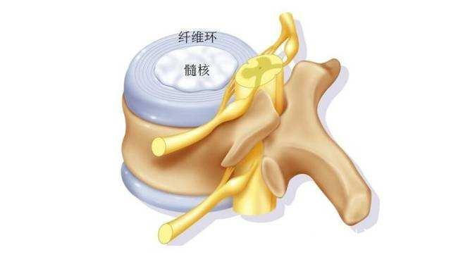 神经根|腰疼、腿麻,检查是腰间盘突出3个病例让你看病再也不花冤枉钱