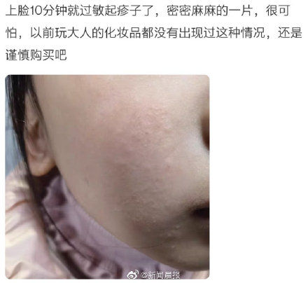 儿童彩妆使用后皮肤过敏溃烂