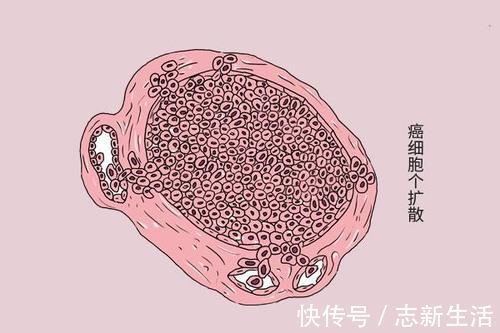 肿瘤|癌症患者,吃得太好,是在为癌细胞输送养分?一文解释清楚