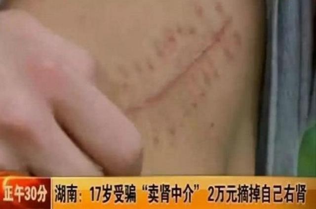 父母|那个“卖肾”买苹果手机的高中生,现状如何?网友:赔上了一辈子