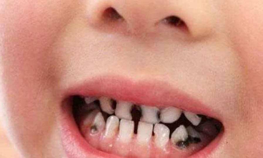 宝宝|4岁孩子一嘴黑牙,妈妈毫不在意认为牙齿能换,牙医叹气无知