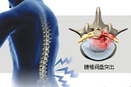止痛药|16个字总结腰椎间盘突出症该如何保守治疗！