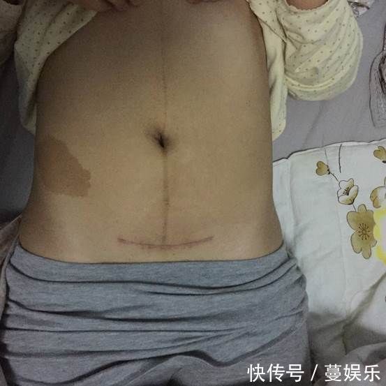 妈妈们|剖腹产的伤口,对女性身体会不会产生伤害,妇产科医生说出真相