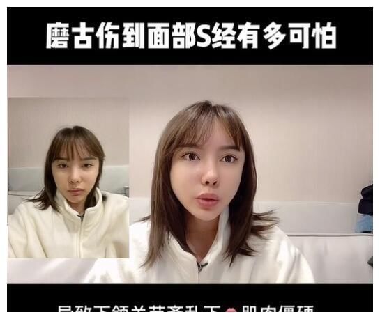 真实颜值|美女网红花70万却整形失败,磨骨伤到神经毁容,自叹非常后悔