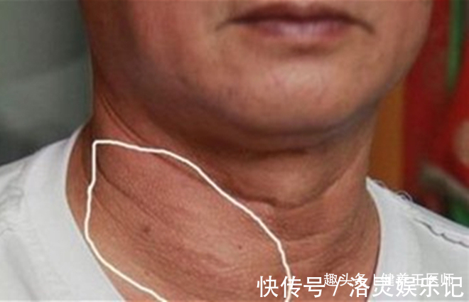 女性|女性有癌,脖子先知!脖子出现这种情况,建议你最好赶紧去检查!