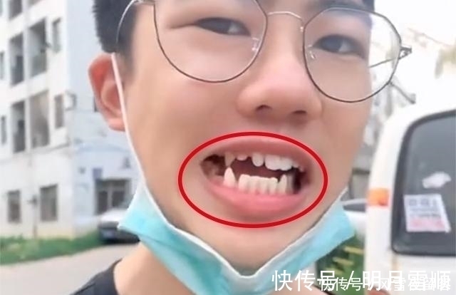 妈妈|17岁孩子长尖牙,妈妈以为是假的,亲手摸过后吐槽:像“吸血鬼”