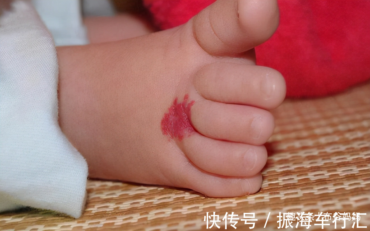 孕期|胎记是怎么来的?产科医生:孕期要避开3种行为,以免宝宝长胎记