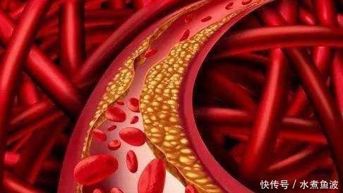 冠心病|三位院士声明开水里加一勺,连喝15天,血管通透明亮,血脂悄悄