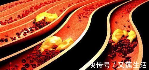 手术治疗|一旦形成就堵塞血管!血栓能自溶?能冲走?真正溶栓方法只有2种