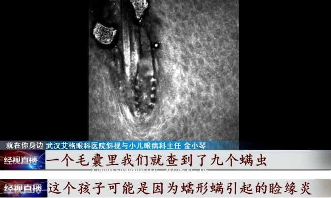 拔掉|眼睛奇痒,10岁女孩拔光睫毛,元凶竟是它