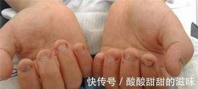 圆圆|5岁女孩喜欢“咬指甲”,宝妈无奈求医,医生太晚了,拔了吧