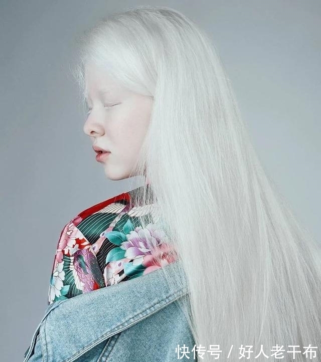 白化病|这对神奇的姐妹俩，曾一出生便浑身“无颜色”，如今粉丝遍布全球