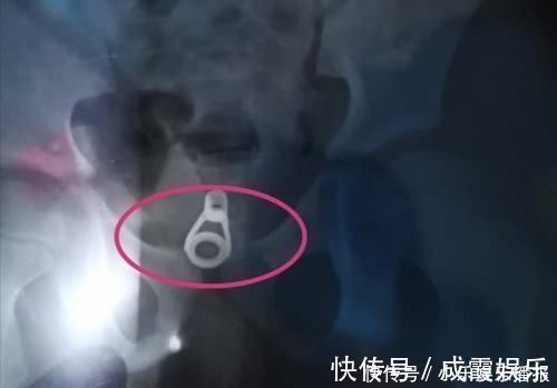 医生|为救六岁女童医生小心翼翼,家长一定不要额外损伤