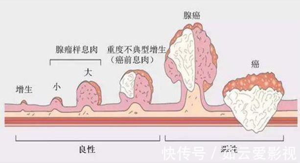 黏膜|医生提示:看似是小病,其实是癌前病变,这4种病,很少人放心上