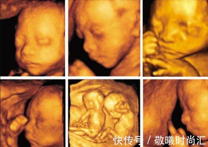 染色体|同样是怀孕，为啥单胎需要做唐氏筛查和四维彩超？而双胎没必要做