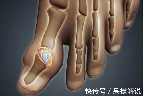 人体|3种食物是尿酸的“催化剂”,不想痛风缠身,尽量要少吃