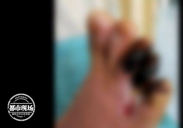 脚趾|男子3个脚趾全都变黑坏死，快停止这个习惯