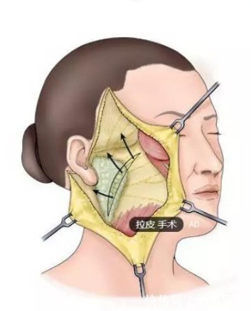 伤口 小拉皮手术恢复期多久？科普篇！想要年轻5岁不再是异想天开