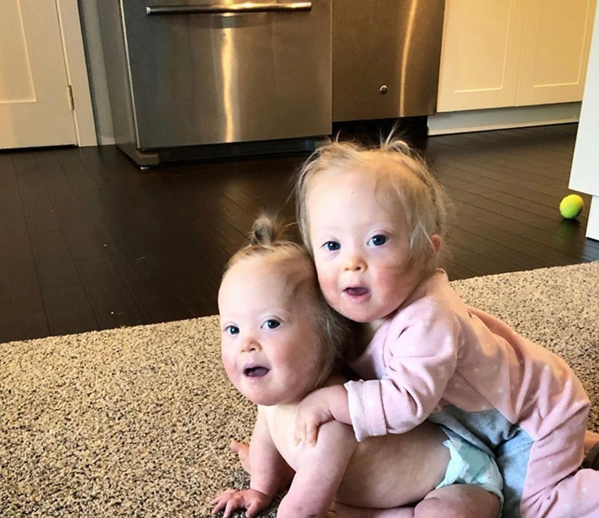 病症|产妇生下唐氏双胞胎姐妹,并没有放弃,网友唐宝都有一张国际脸