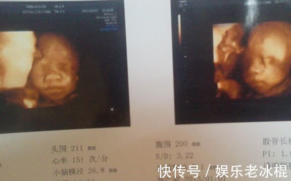 孕妇|这3种孕检已经被叫停,别再傻傻去做了,不仅费钱还浪费时间