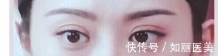 手术 什么样的双眼皮手术意味着失败了?术后多久才能进行二次修复?看完这篇,你就知道啦~