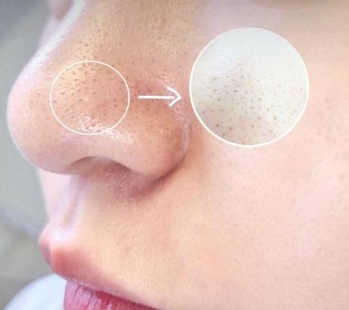 脸上、鼻子上挤出来的白色丝状物，到底是什么？医生一文讲明白