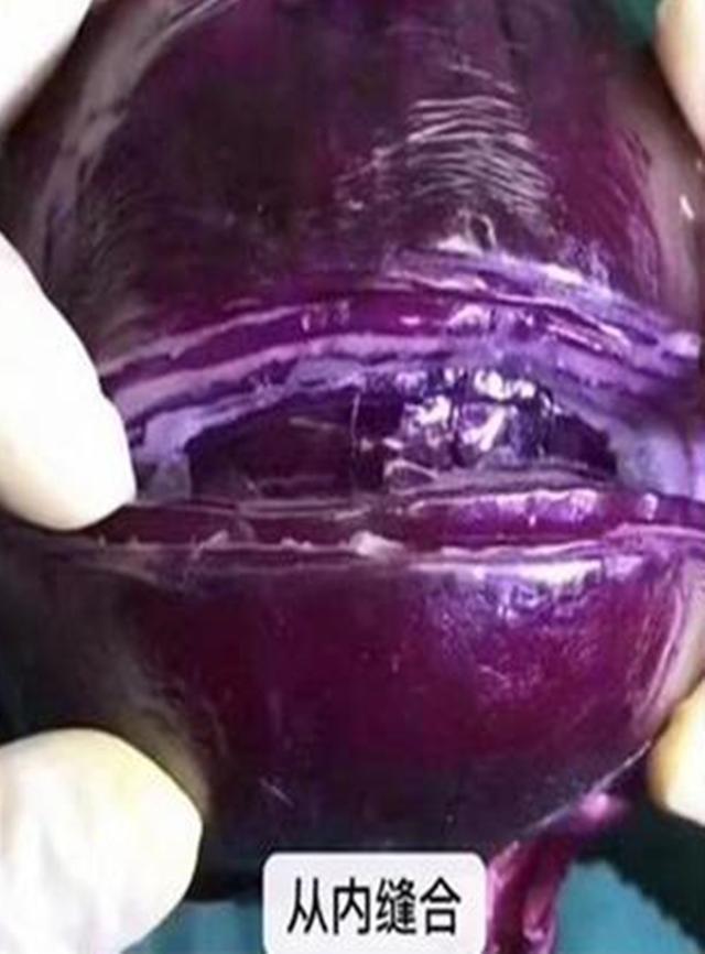 麻醉针|选剖腹产不疼这根10厘米的麻醉针仅仅是开始,疼到你怀疑人生