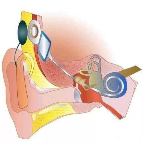 听力|关于人工耳蜗植入，你了解多少？