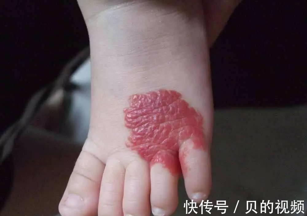 孕期|这三种孕妈容易生出“胎记宝宝”,和孕期行为习惯有关,多上点心