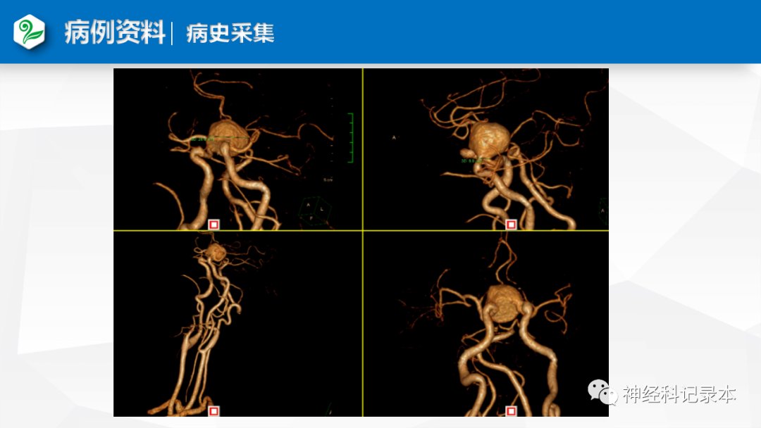 溶栓|特殊情况下静脉溶栓决策两例