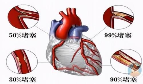  出现“动脉斑块”，还能逆转吗？听医生怎么说