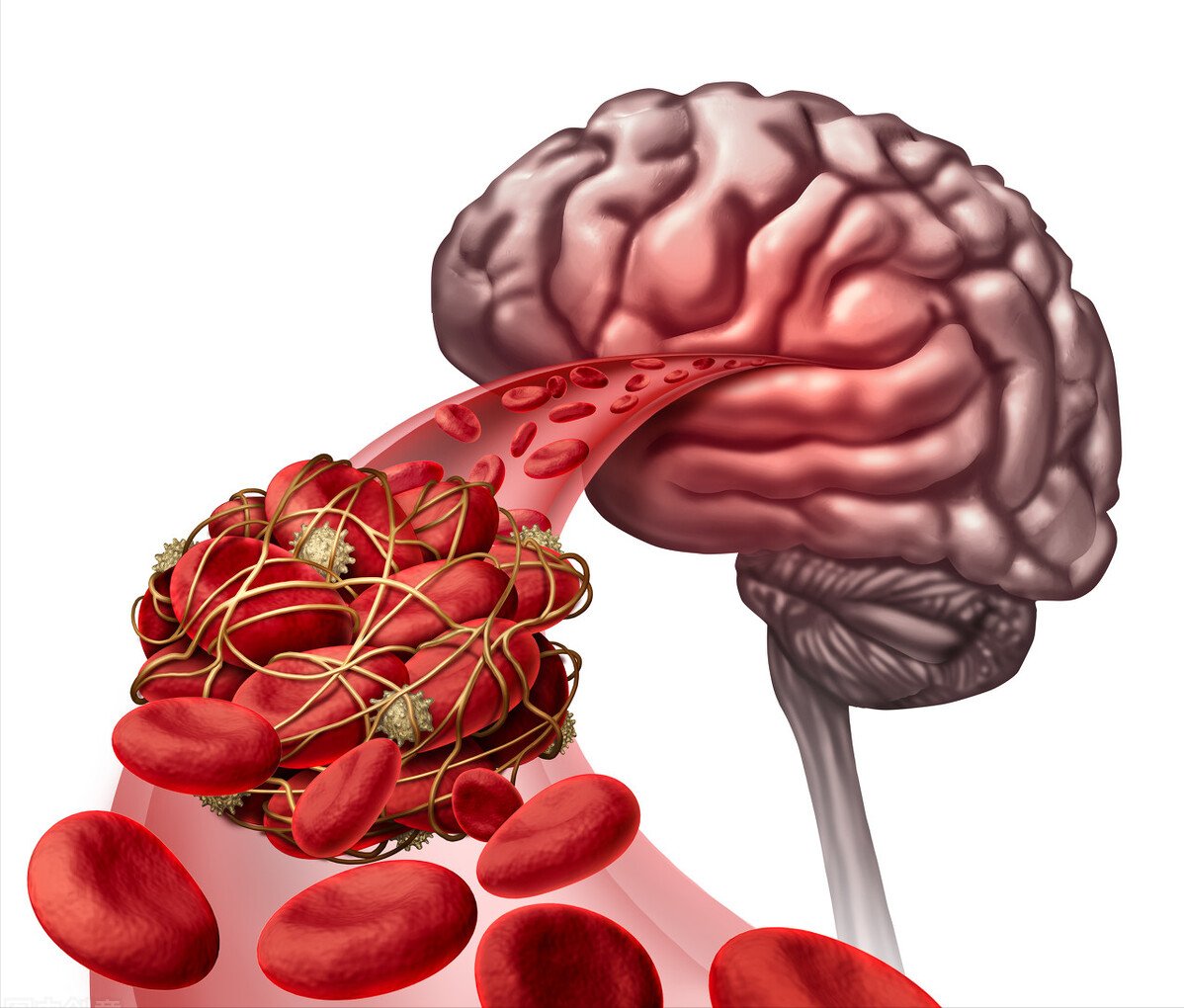 动脉粥样硬化|2个中成药,辅助降三高,抗动脉粥样硬化,标本兼治心、脑血管病