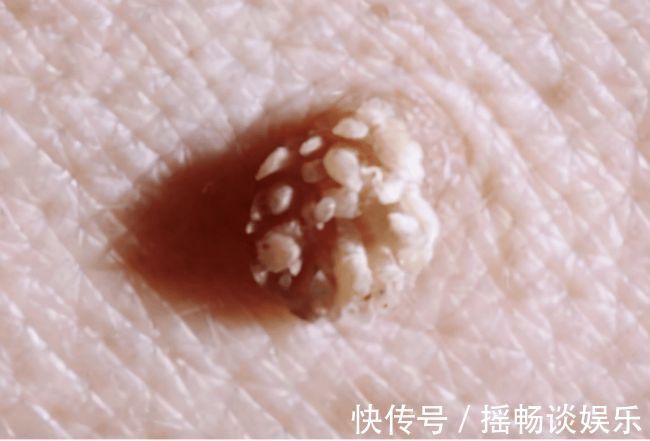晨晨|19岁女大学生感染HPV,肉芽疙瘩遍体,医生:80%就诊的都是大学生