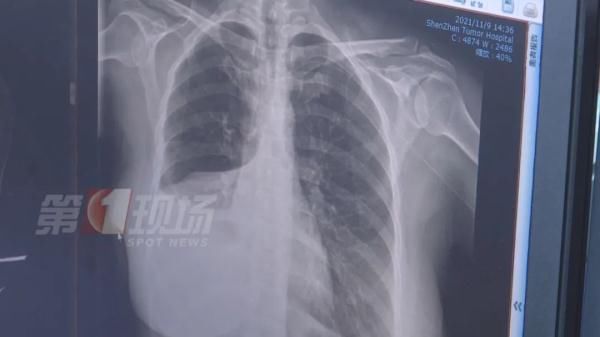 胸外科|手指肿成“萝卜头”，一查竟是肺癌！警惕身体发出的这些信号