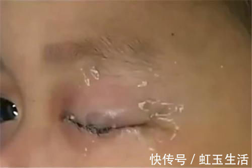 家长|4岁女儿误将胶水滴入眼睛,宝妈临危不乱的做法,医生直夸有文化