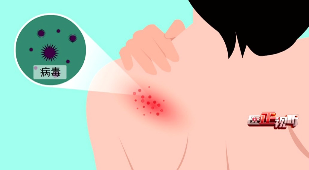 主任医师|蛇盘疮绕一圈就无药可救了?谣言!快来了解这种病