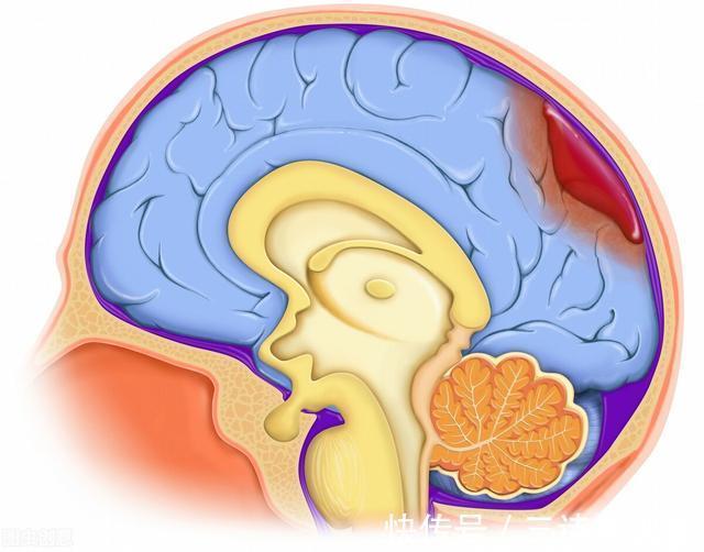 办法|家人突发脑出血咋办?医生教你家庭急救办法,家人有高血压的请看