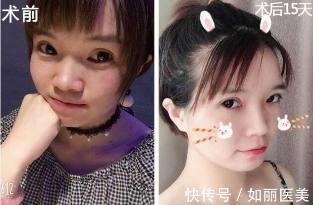 我们来了 双眼皮手术后遗症:宽、深、痕,这些现象很常见!