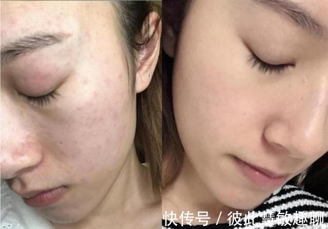 肌肤|我国一“低调”洁面皂,高质价低,能除螨祛痘消闭口,却少有人知