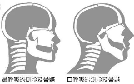 不良习惯|这样的睡姿你家宝贝是否也有呢？其实这都是口呼吸惹的祸！