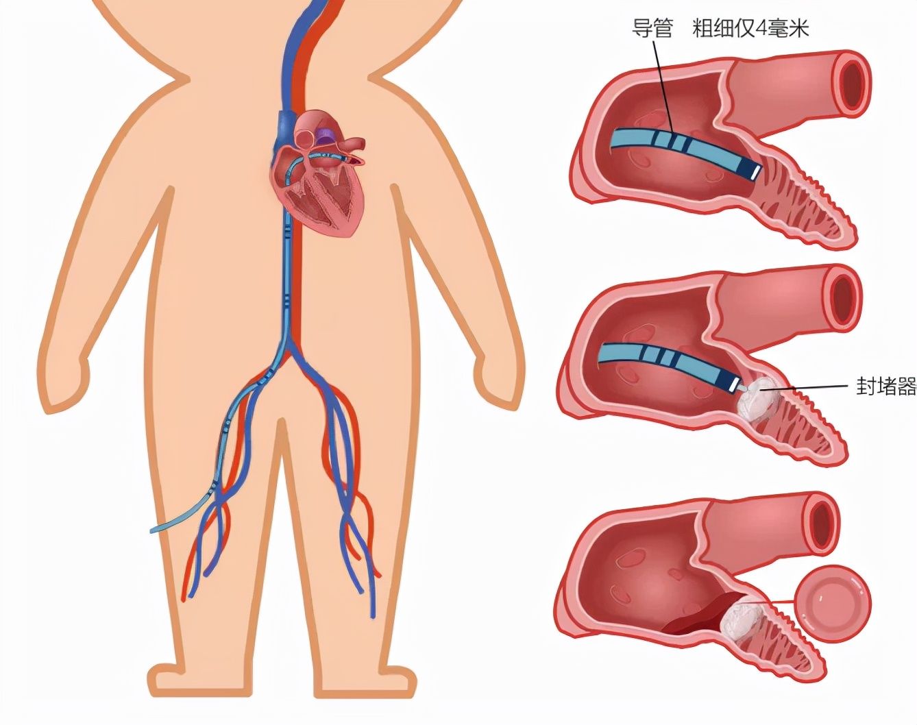 起搏器|“心门”坏了、冠脉堵塞、心脏乱跳,一根导管解决诸多心脏顽疾