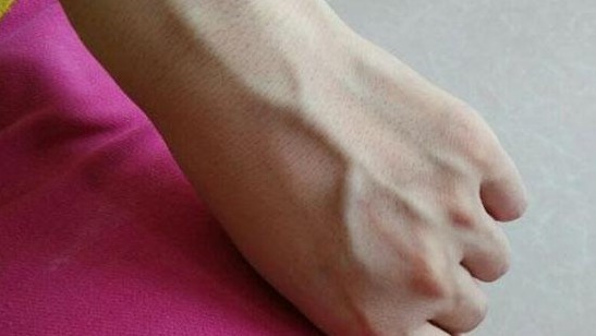 苏子油|血管不好，手先知，手上出现3个迹象，暗示血管已经很堵了