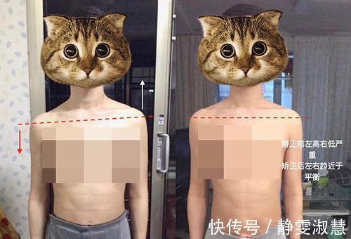 变形|4个月宝宝被查出“脊柱变形”,只因妈妈带他出门时,总爱这么做