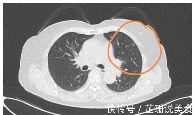 王教授|北大人民医院刘医生父亲查出了肺癌，希望放弃治疗，我没同意