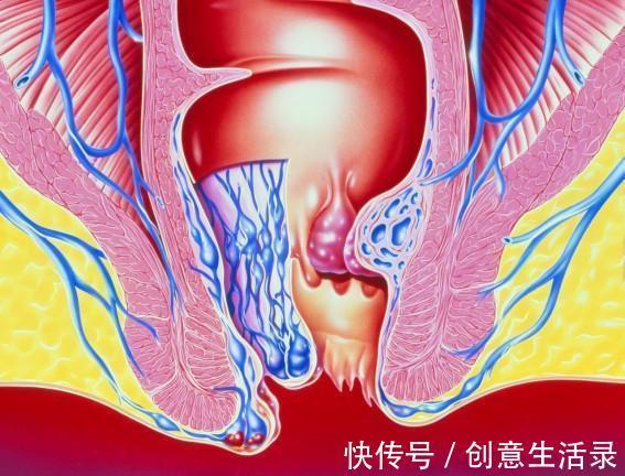急性发作|痔疮最佳的自愈方法？这招太狠了，轻松治好我10年混合痔！