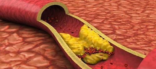 高血脂|天然“他汀”放1勺，连喝15天，专攻高血脂、疏通血管、血栓不来